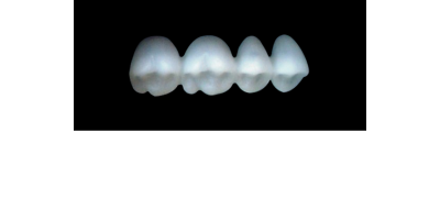Cod.S4UPPER RIGHT : 15x  posterior solid (not hollow) wax bridges, X-SMALL, (14-17) , with precarved occlusion to Cod.S4LOWER RIGHT,and compatible to Cod.E4UPPER RIGHT (hollow), (14-17)